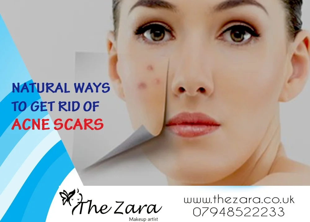 Natural Ways to Get Rid of Acne Scars
